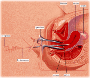 hysteroscope1