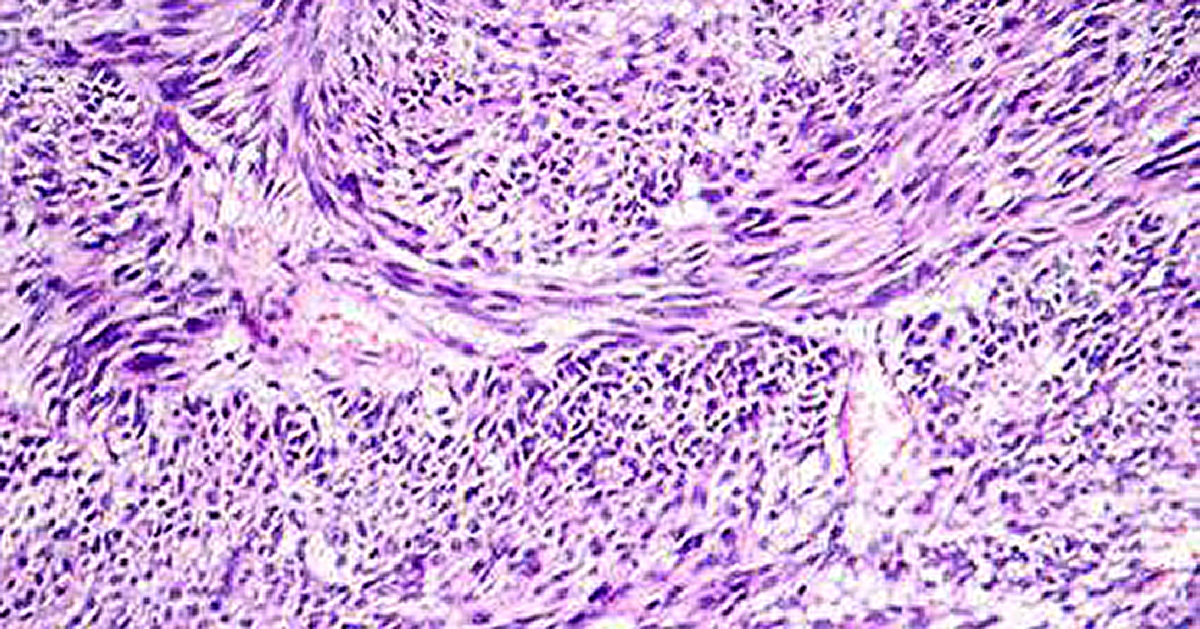 Fibroids