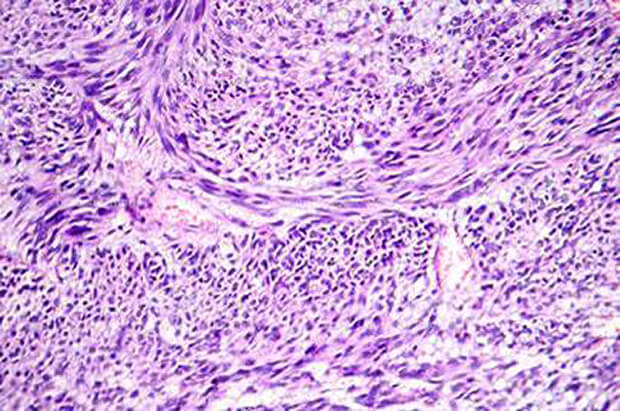 Can Fibroids Affect Your Fertility?